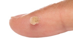 Die Warze ist eine Hautkrankheit, kann wirksam bekämpfen Skincell Pro